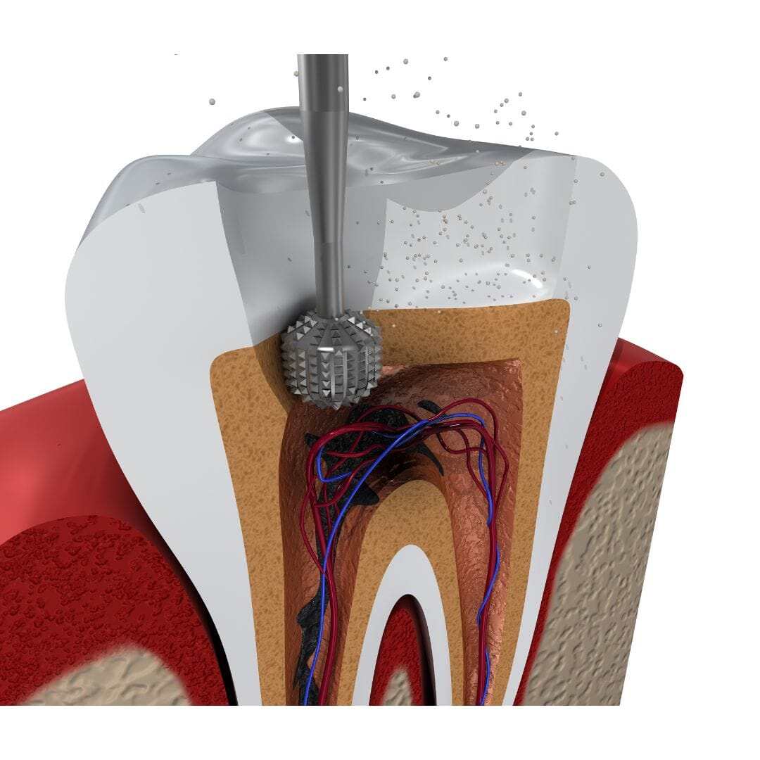 Cross-section illustration of an instrument entering the crown of a tooth to reach the pulp