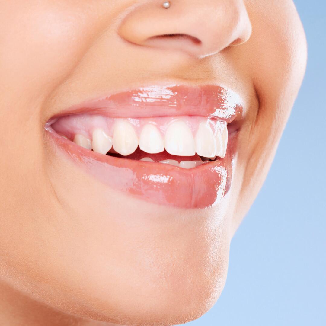 Close-up of an even, bright smile after veneer treatment
