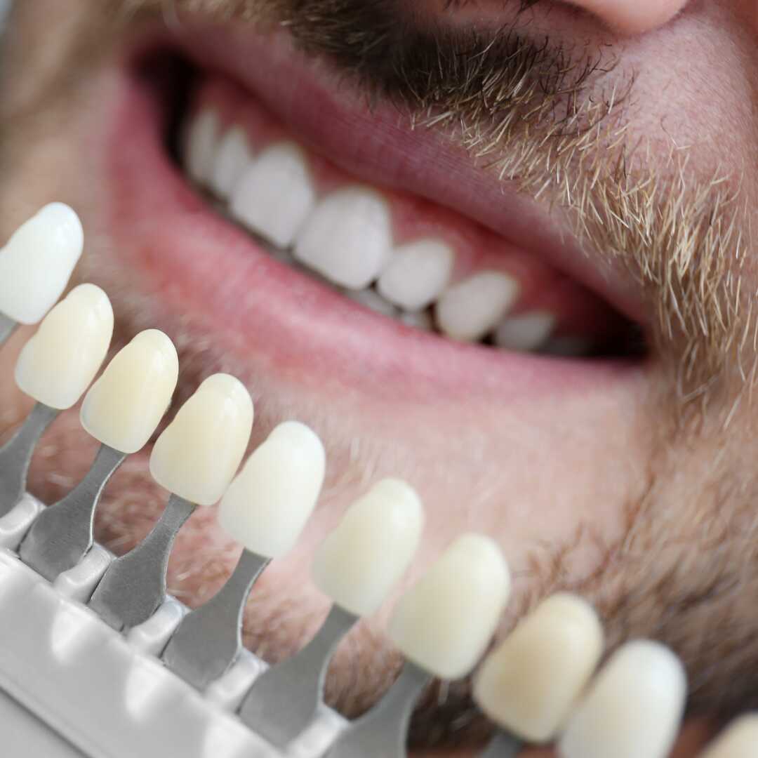 A row of veneer shade samples compared against a patient's natural teeth