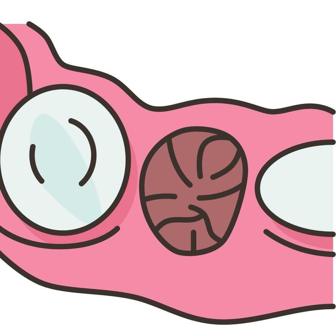 Illustration of a healthy blood clot filling the socket after a tooth is removed