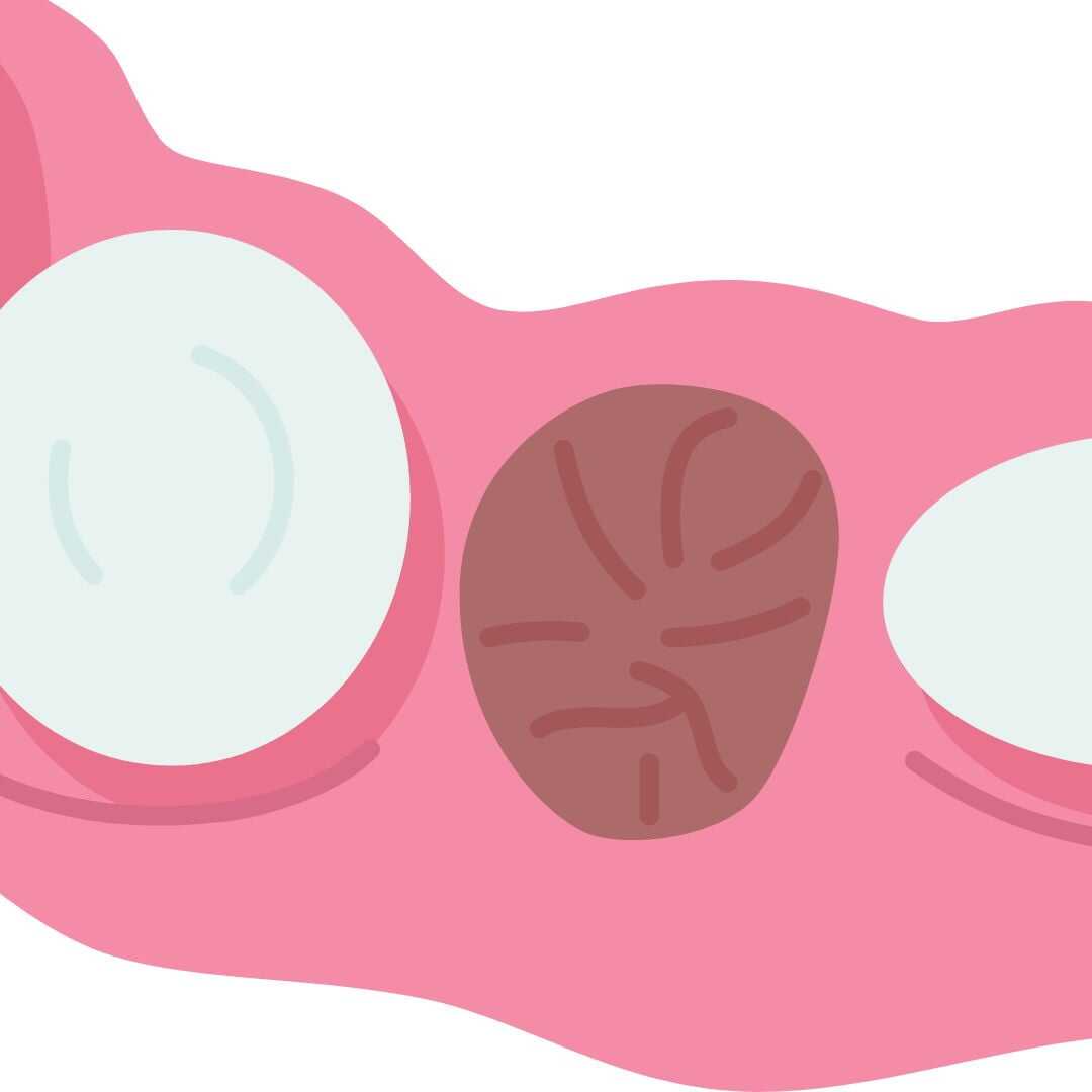 Illustration of a dry socket, where the blood clot has been lost and the bone is exposed