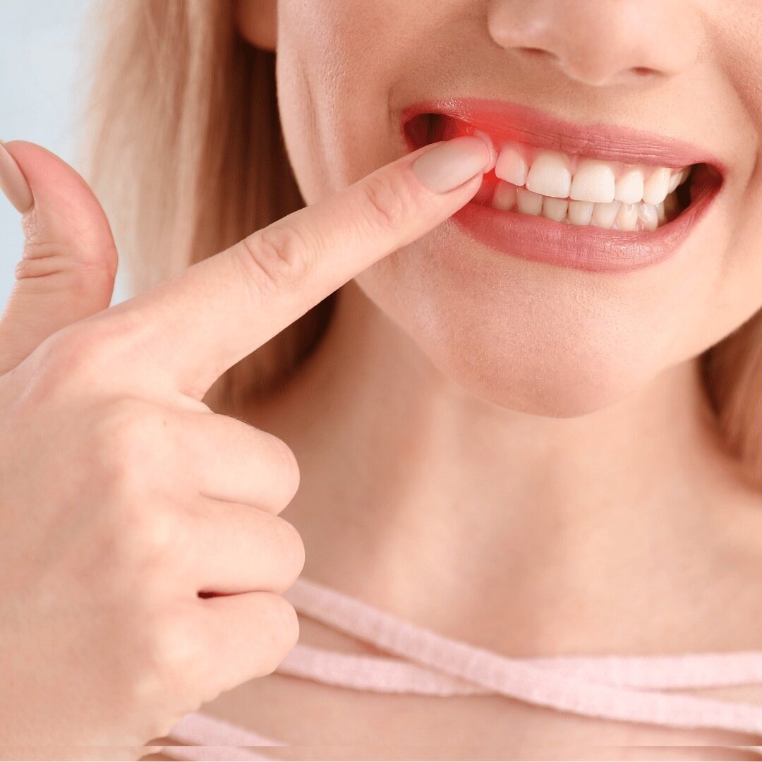 A patient lifting her lip to show red, inflamed gums above the upper teeth