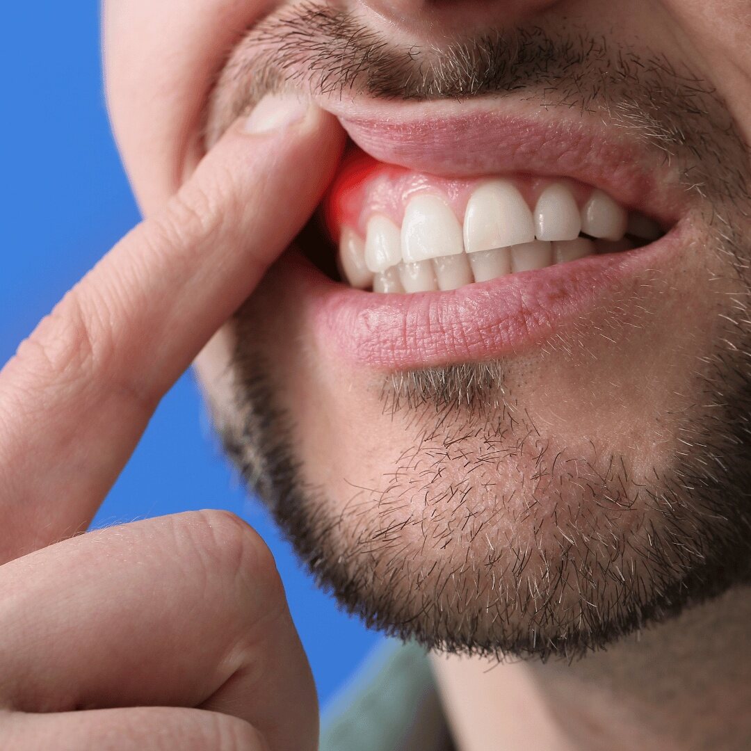 A patient showing swollen, reddened gum tissue above the front teeth