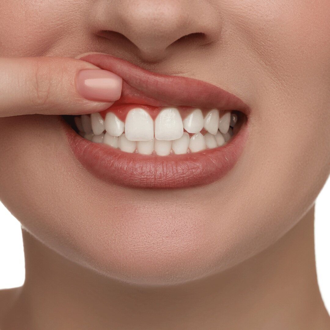 Close-up of gum inflammation along the margin of the upper front teeth