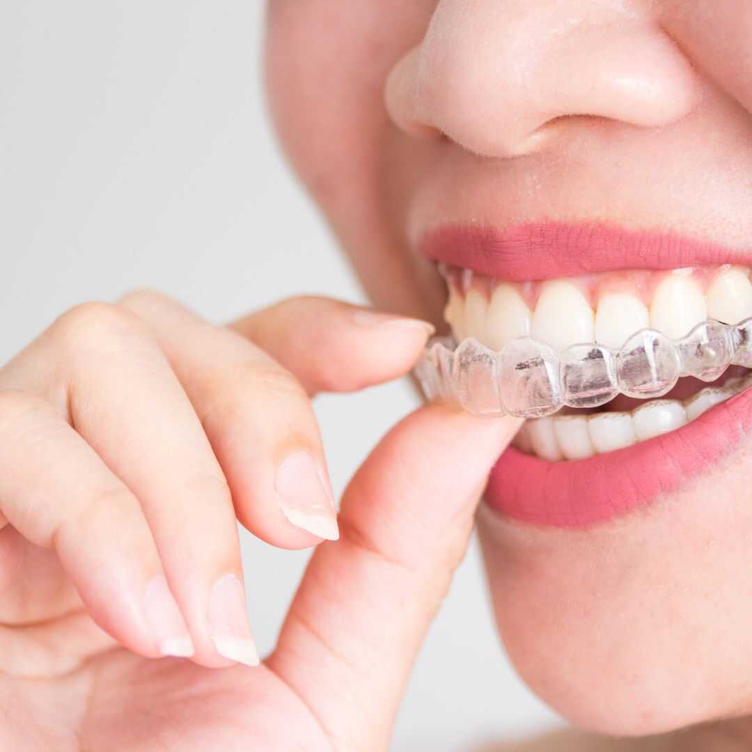 A patient seating a clear aligner over her upper teeth