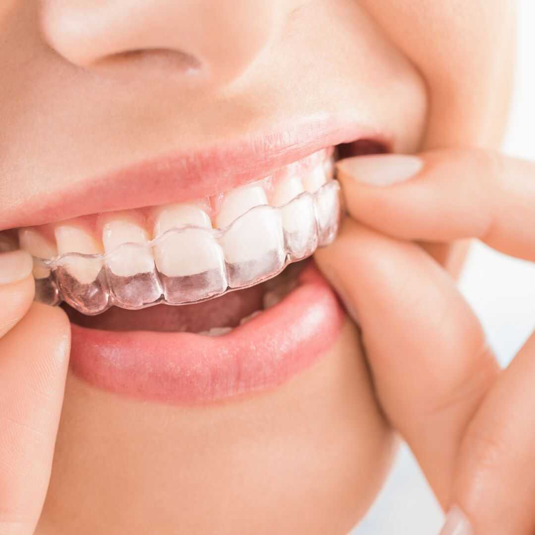 Close-up of a clear aligner being fitted over the front teeth