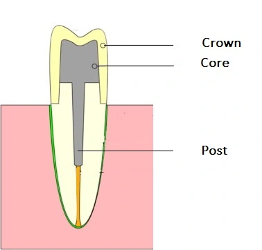 Labelled cross-section of a post and core: the post set into the root canal, the core built over it and the crown on top