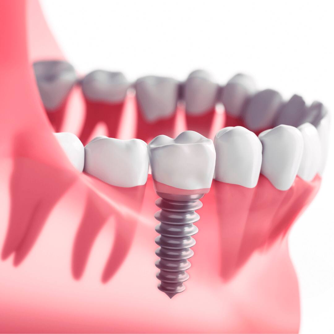 Illustration of a titanium implant post in the lower jaw supporting a row of crowns