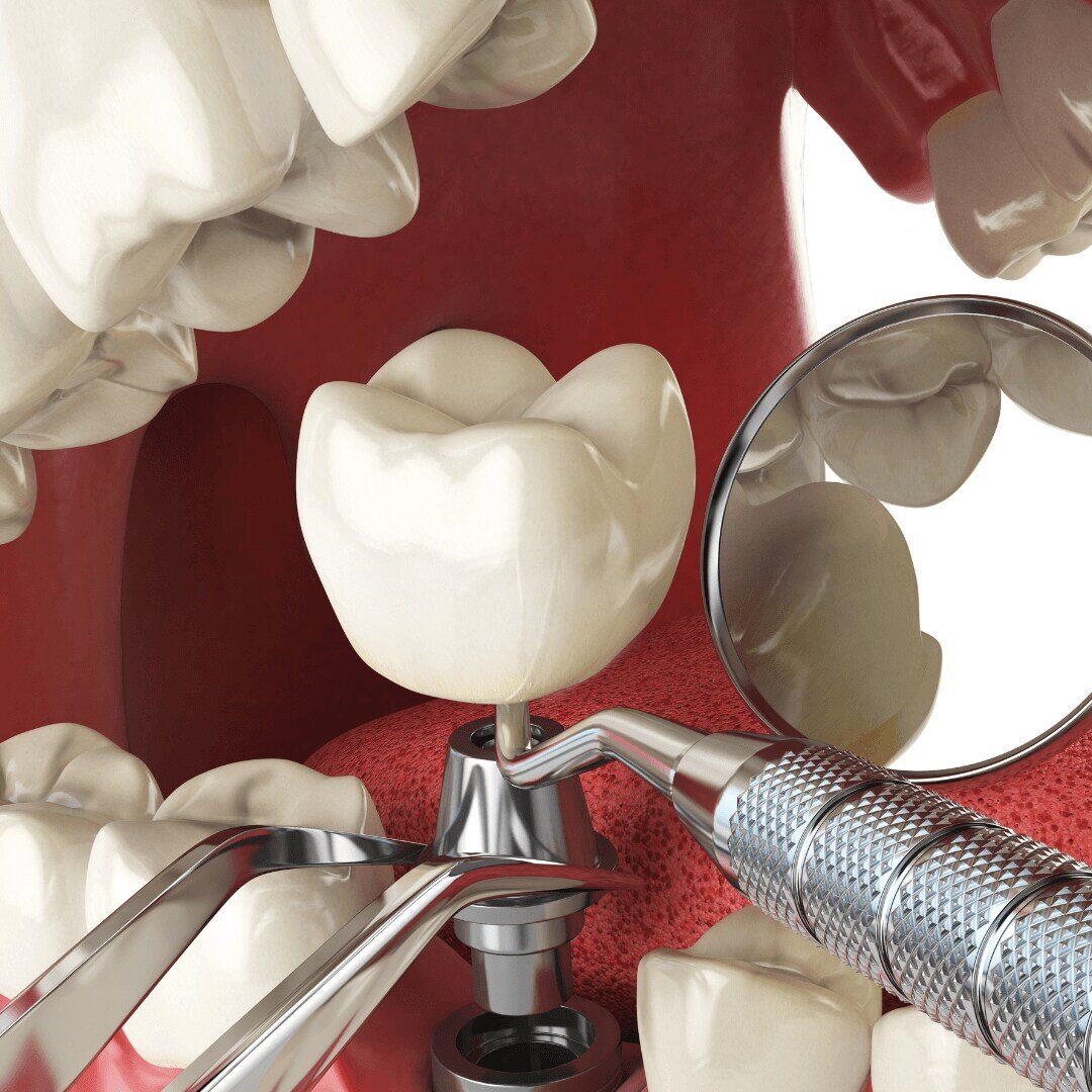 An implant abutment between natural teeth, examined with a mirror and instrument