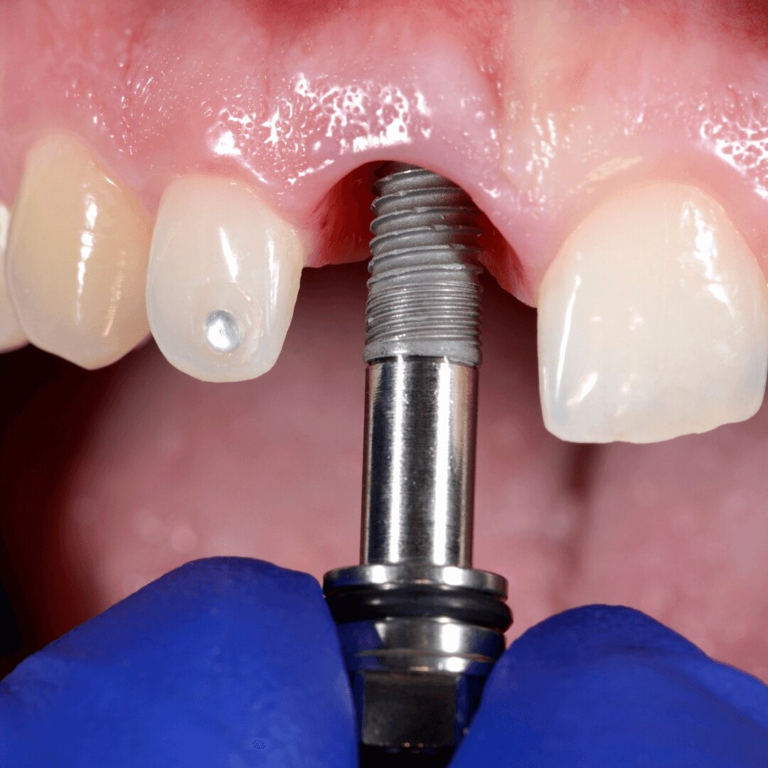 A dental implant being unscrewed from the upper jaw with a driver
