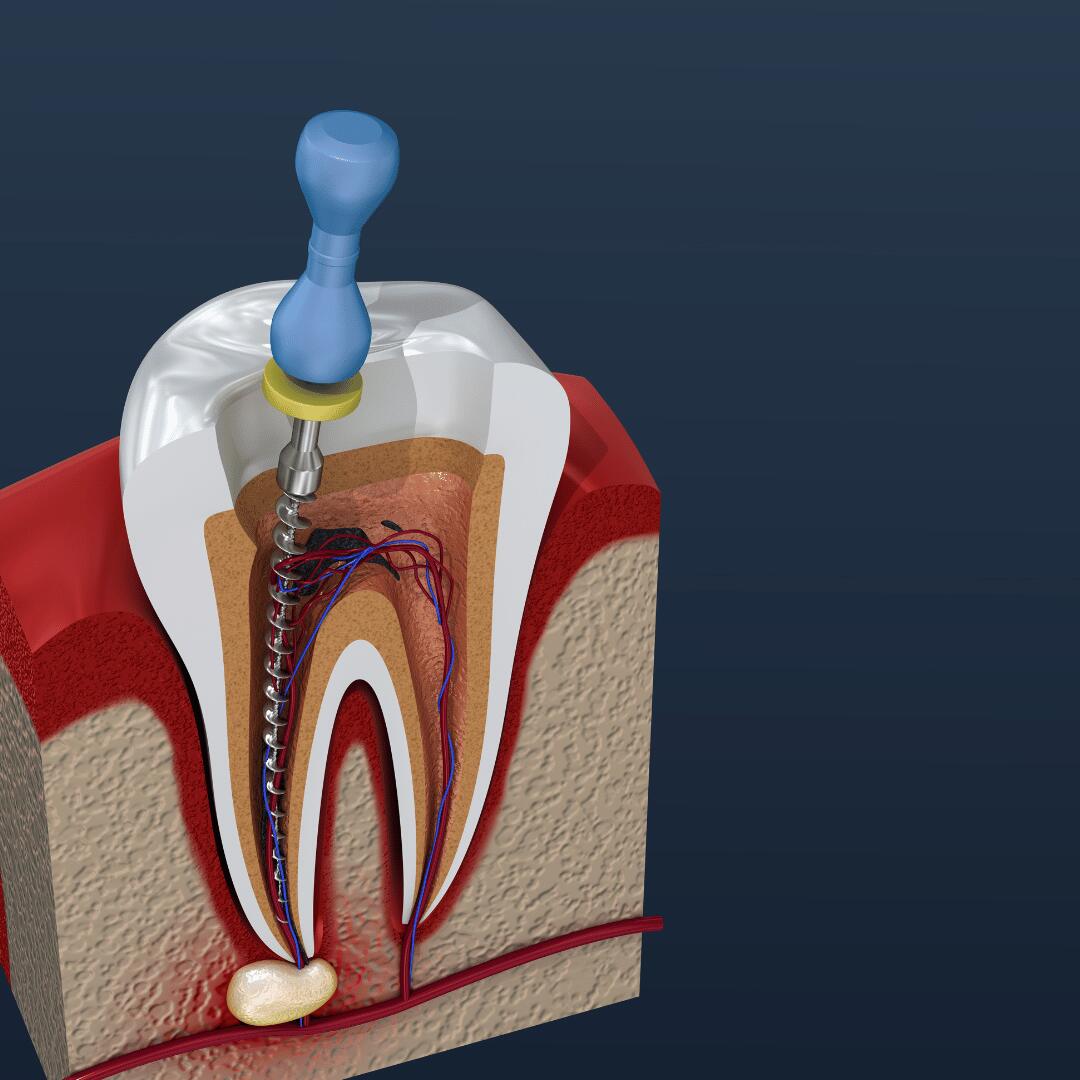 Cross-section illustration of a tooth with an infection at the root tip, sealed after root canal treatment