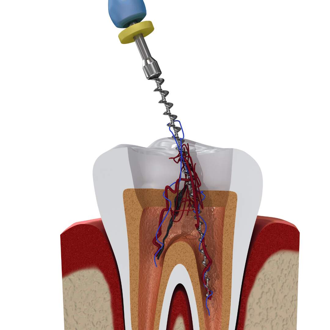 Illustration of an endodontic file cleaning and shaping the root canal of a tooth