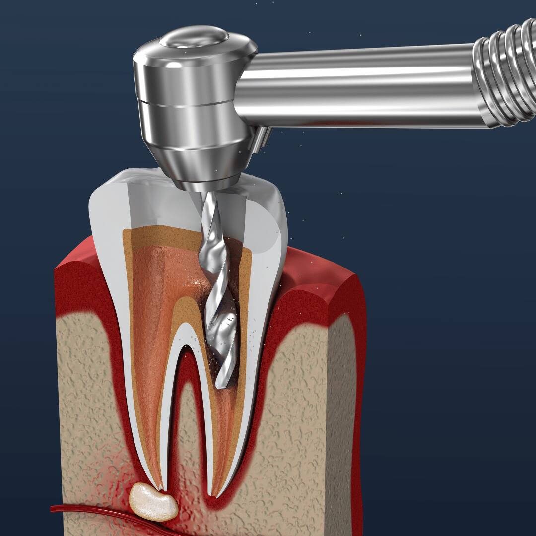 Illustration of a dental handpiece opening the crown of a tooth to reach the pulp chamber