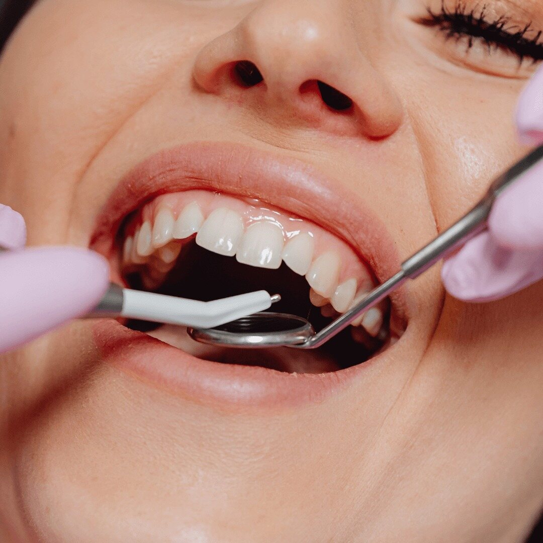 A dentist examining a patient's upper front teeth with a mirror and probe