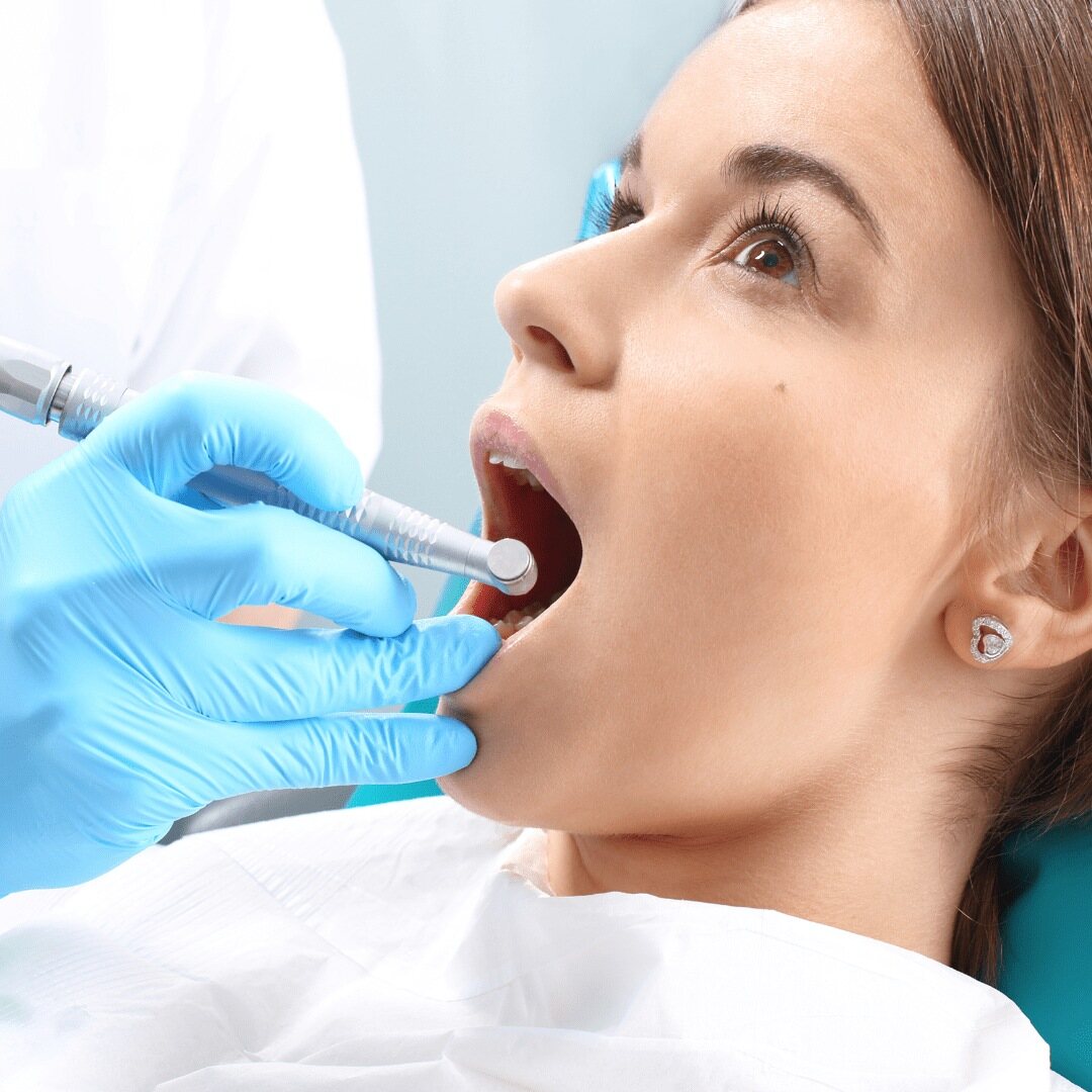 A tooth being prepared with a handpiece during root canal treatment
